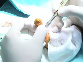Czerniak złośliwy skóry zlokalizowany na paliczku – leczenie chirurgiczne za pomocą amputacji